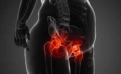Hip replacement and obesity: our recommendations | Paris | Inside the Hip