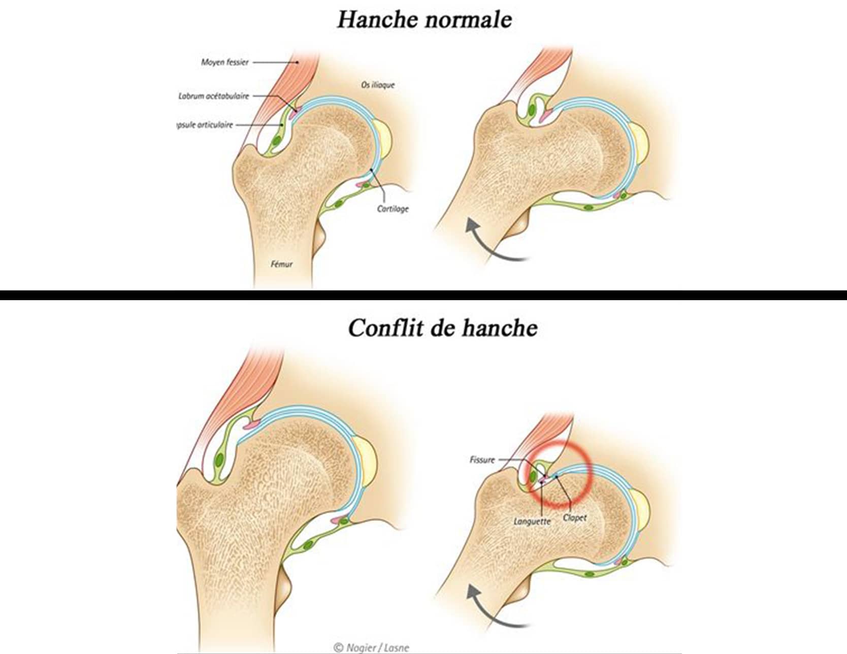 Conflit de la hanche | découvrez les causes et les techniques | Inside the Hip | Paris
