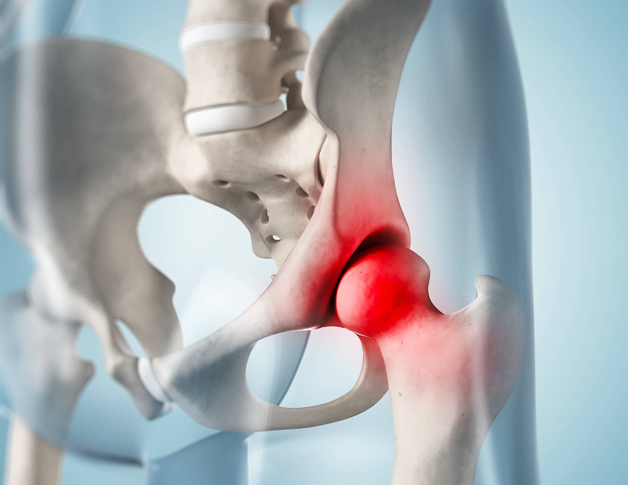 Synovial Chondromatosis | Learn about the causes and procedures | Inside the Hip | Paris