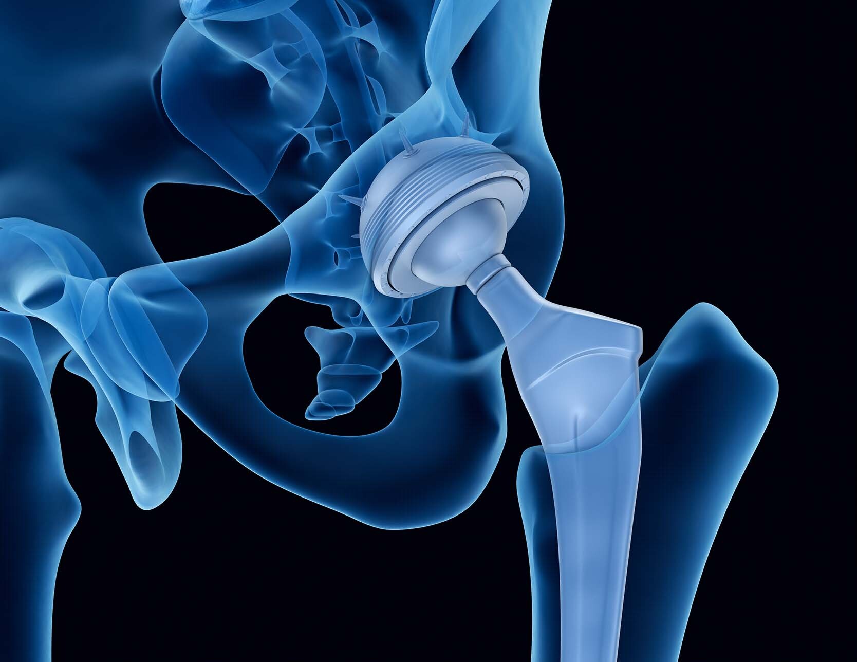 Prosthetic hips | Learn about the causes and procedures | Inside the Hip | Paris