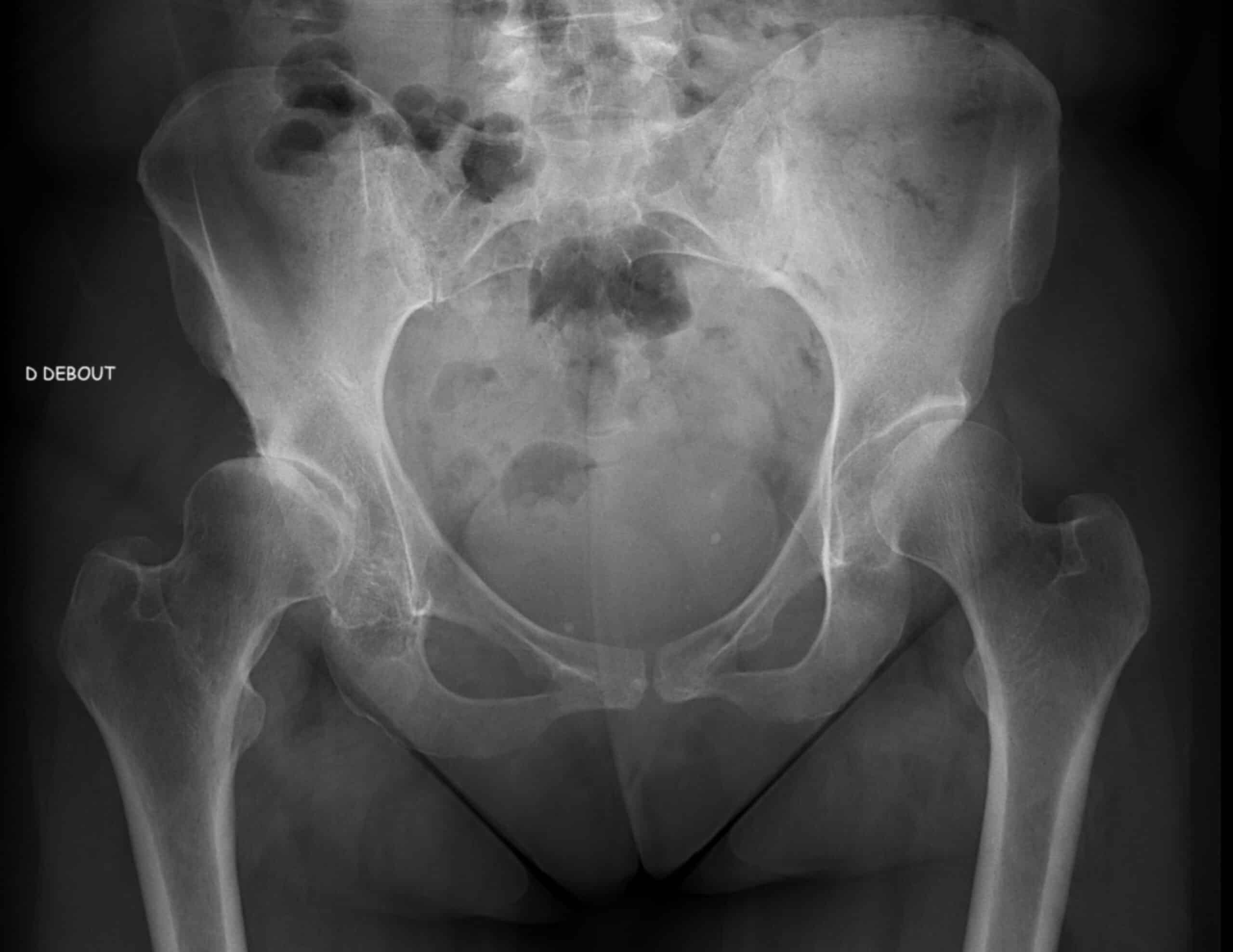 Traitement dysplasie de hanche