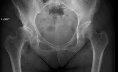 Traitement dysplasie de hanche