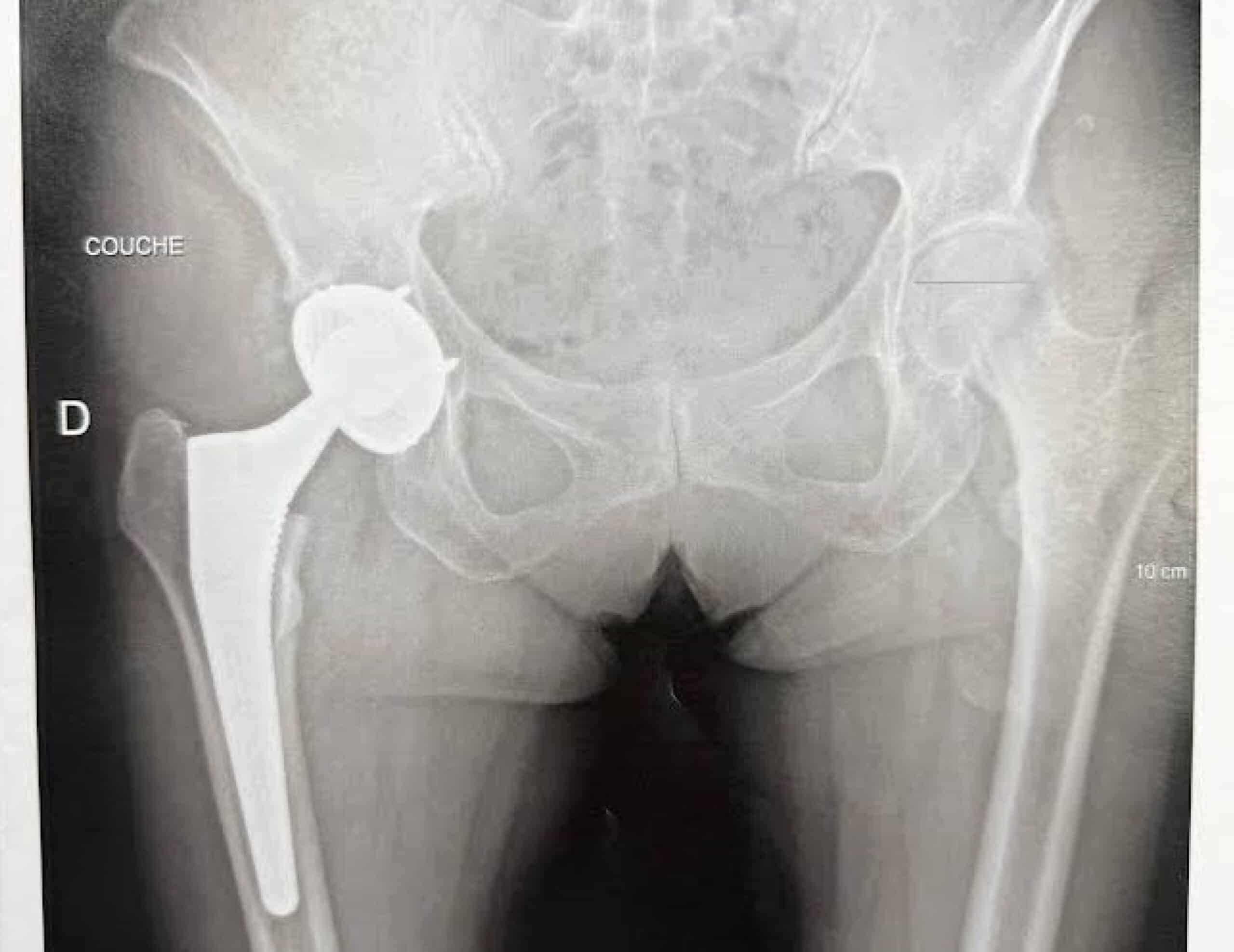 Inégalité de longueur prothèse hanche