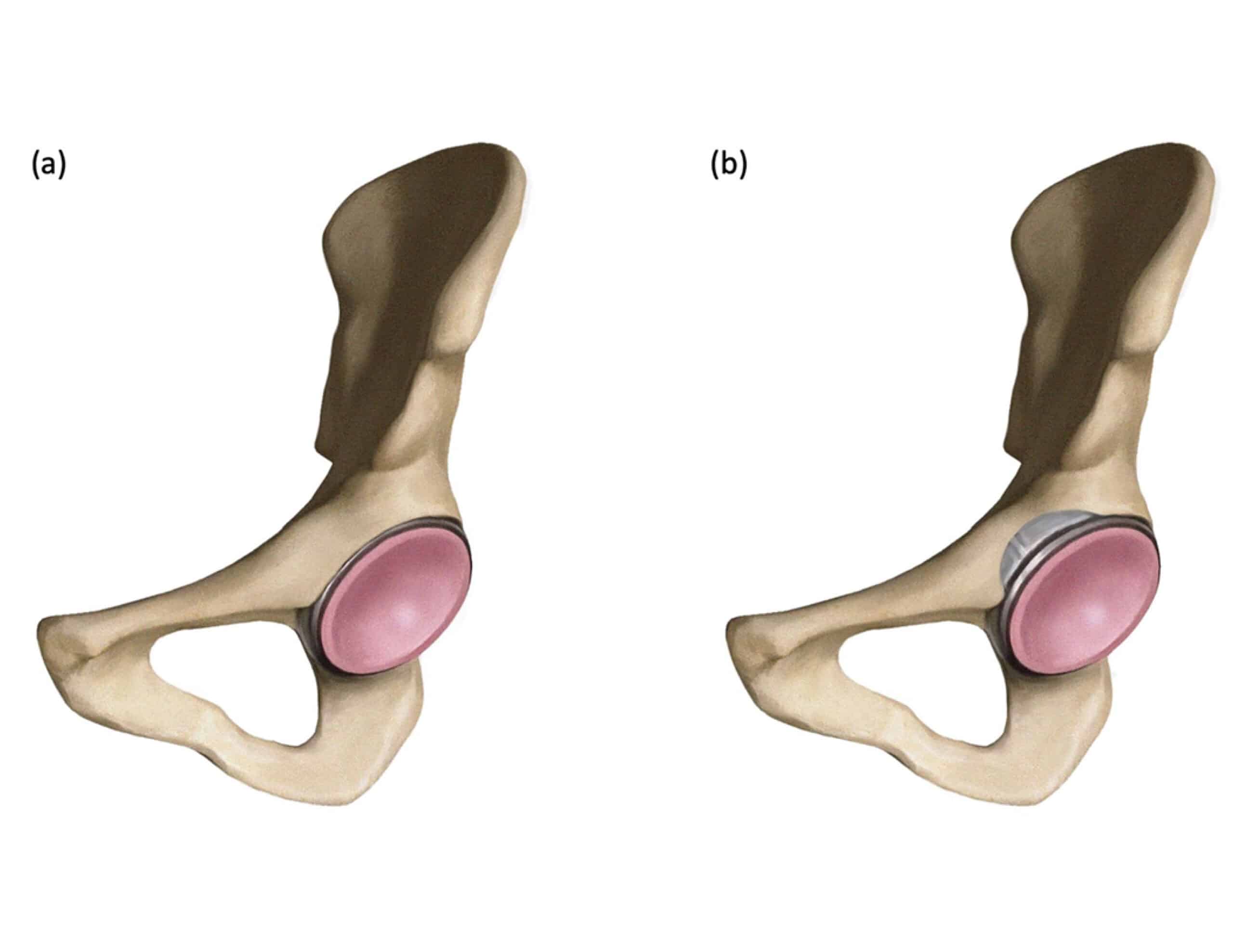 anterior acetabular wall