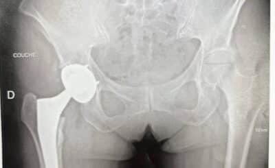 Inégalité de longueur prothèse hanche