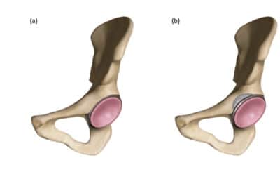 anterior acetabular wall