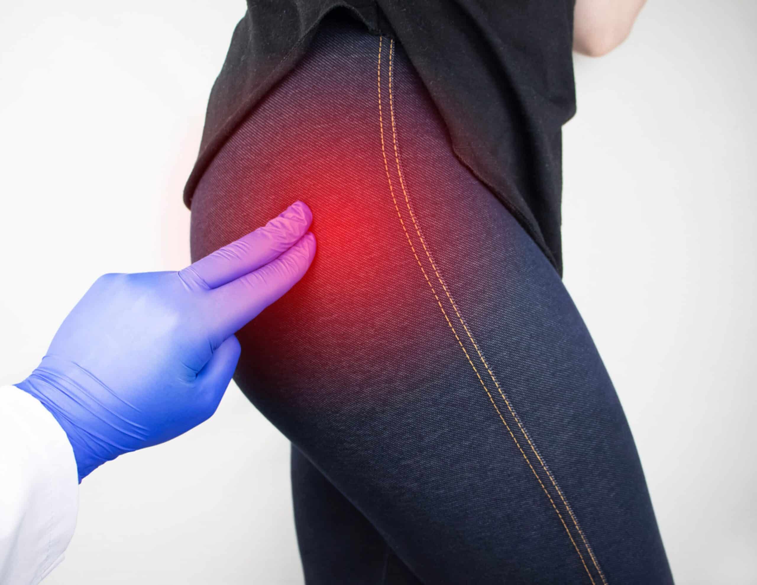 Douleurs trochantériennes