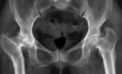 Hanche multi-opérée