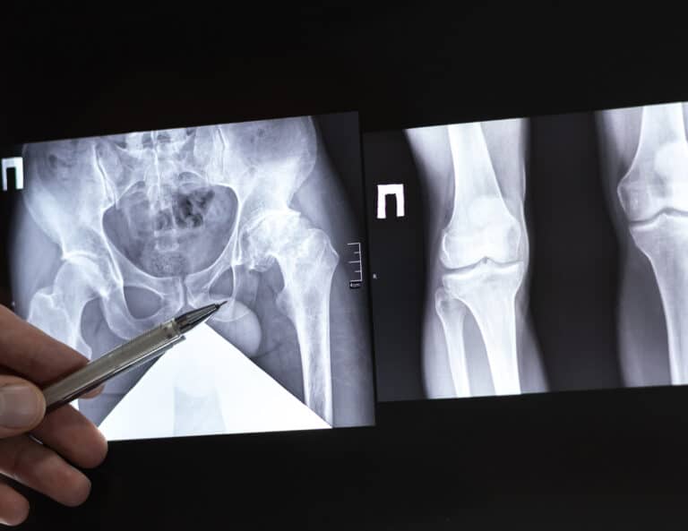 Recognize and treat hip osteoarthritis | Paris and Lyon | Inside the Hip