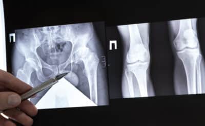 Reconnaître et traiter la coxarthrose | Paris et Lyon | Inside the Hip